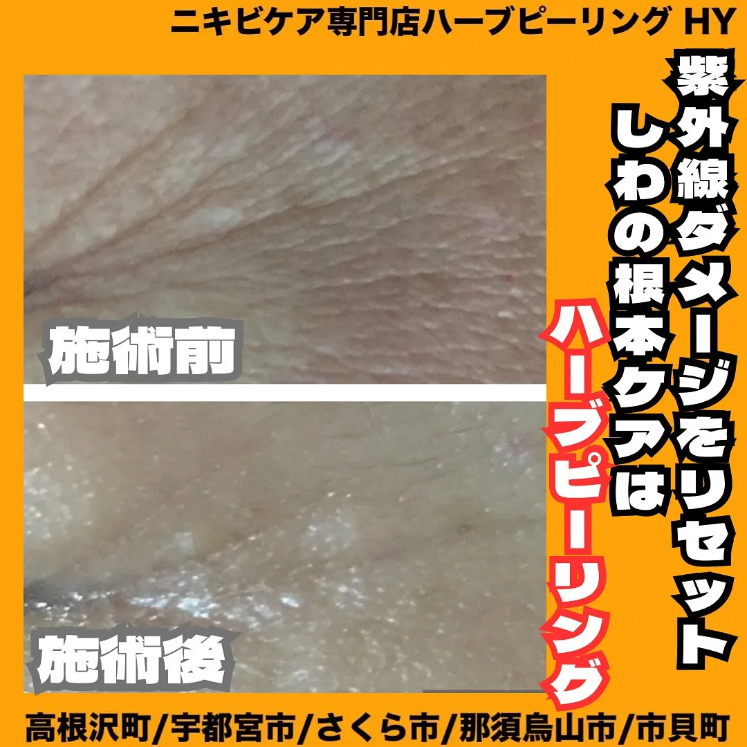 【紫外線ダメージをリセット！しわの根本ケアはハーブピーリング...