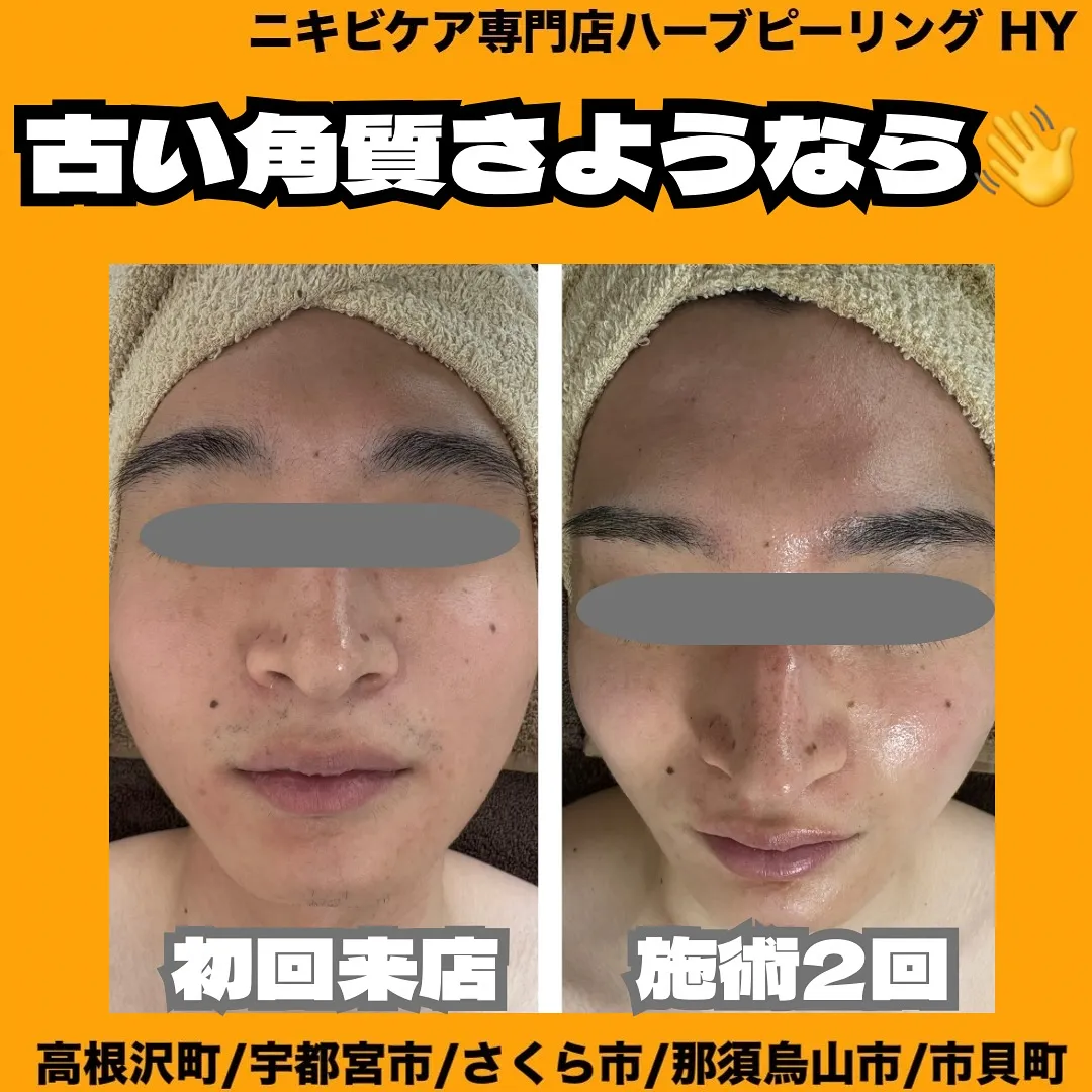 【古い角質さようなら👋】