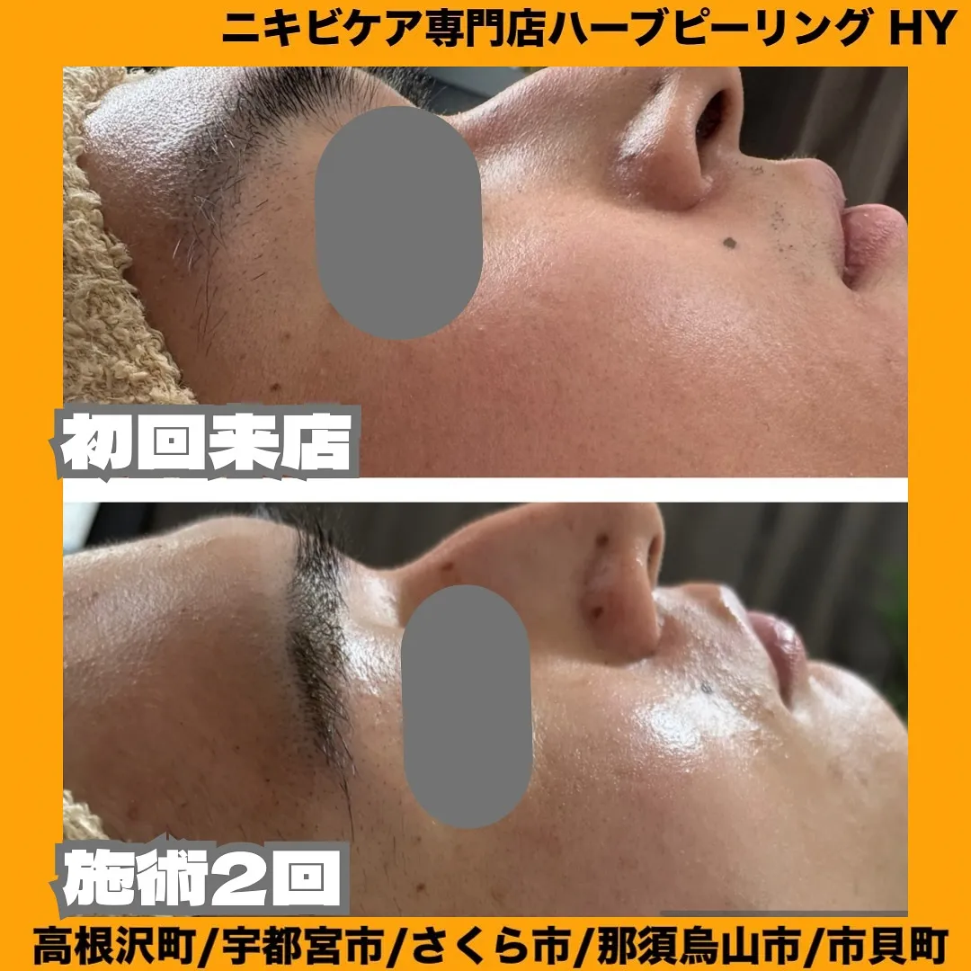 【古い角質さようなら👋】