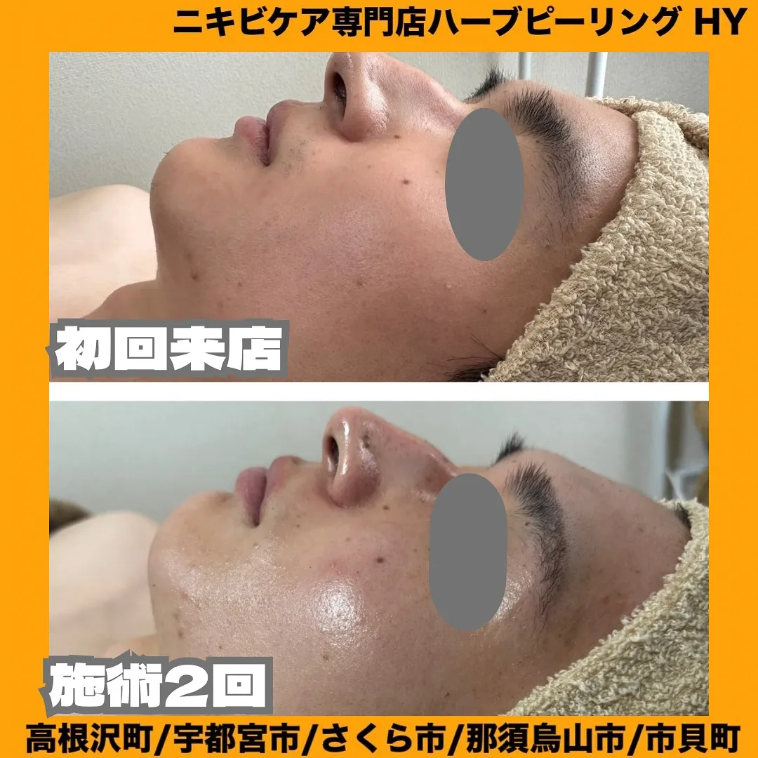 【古い角質さようなら👋】