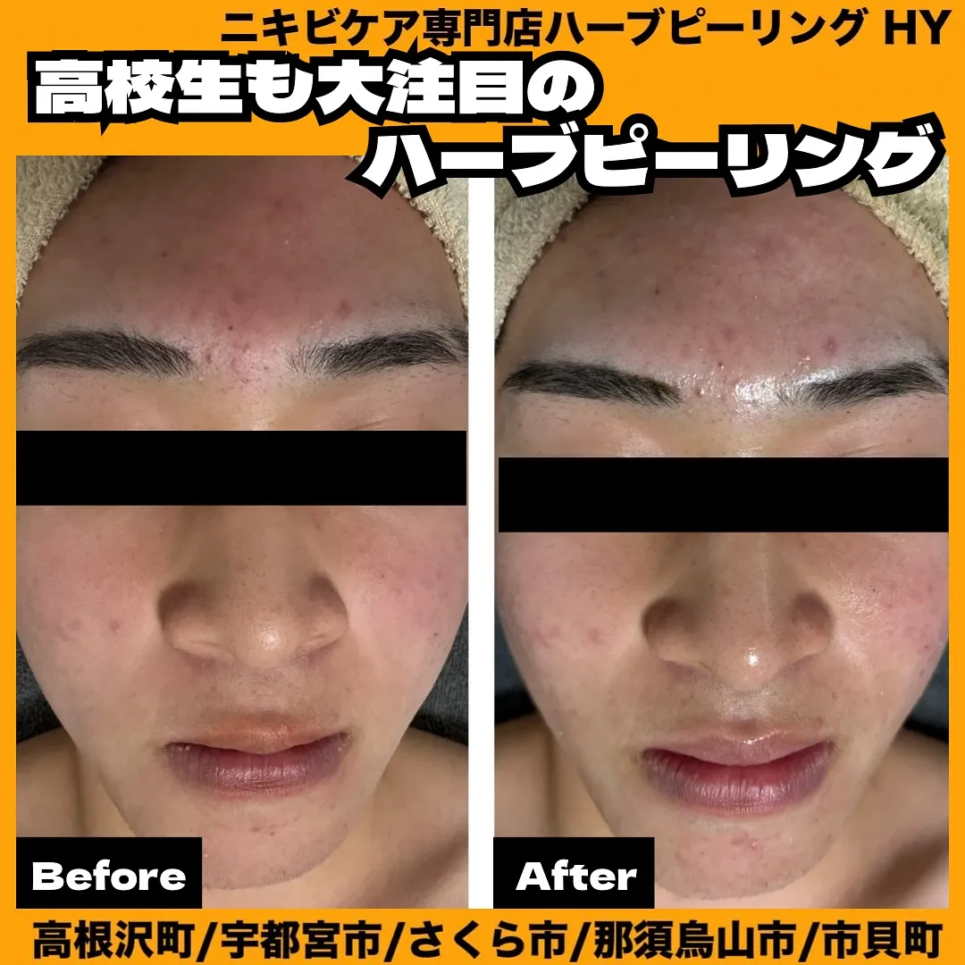 【高校生も大注目のハーブピーリング】