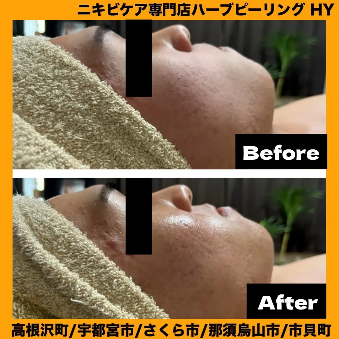 【高校生も大注目のハーブピーリング】