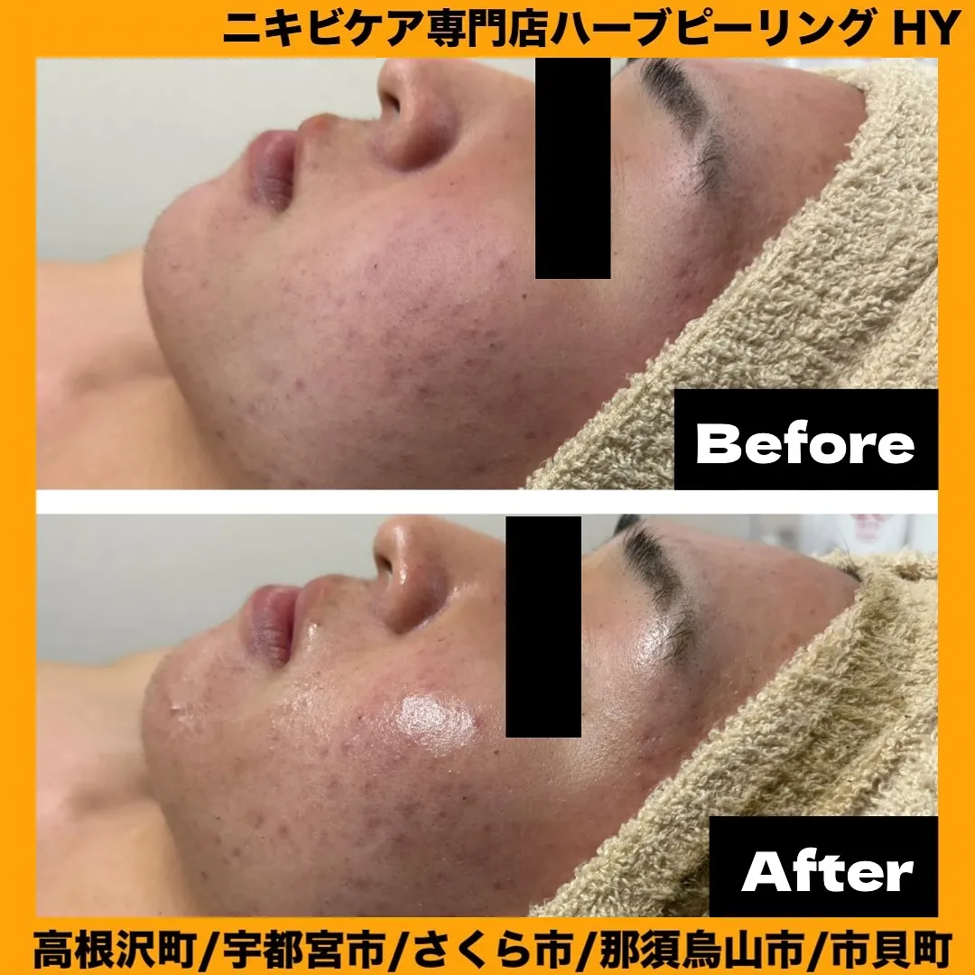 【高校生も大注目のハーブピーリング】