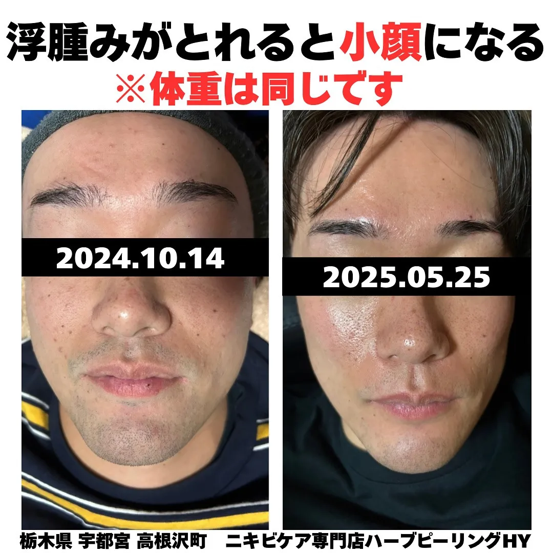 みなさん浮腫んでませんか？