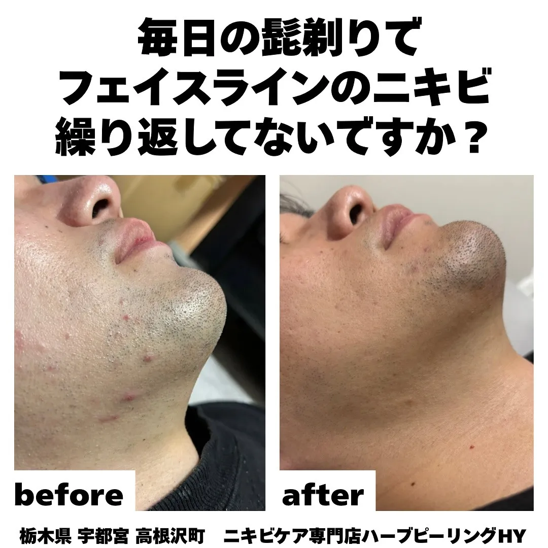 毎日の髭剃りでフェイスラインのニキビが消えない