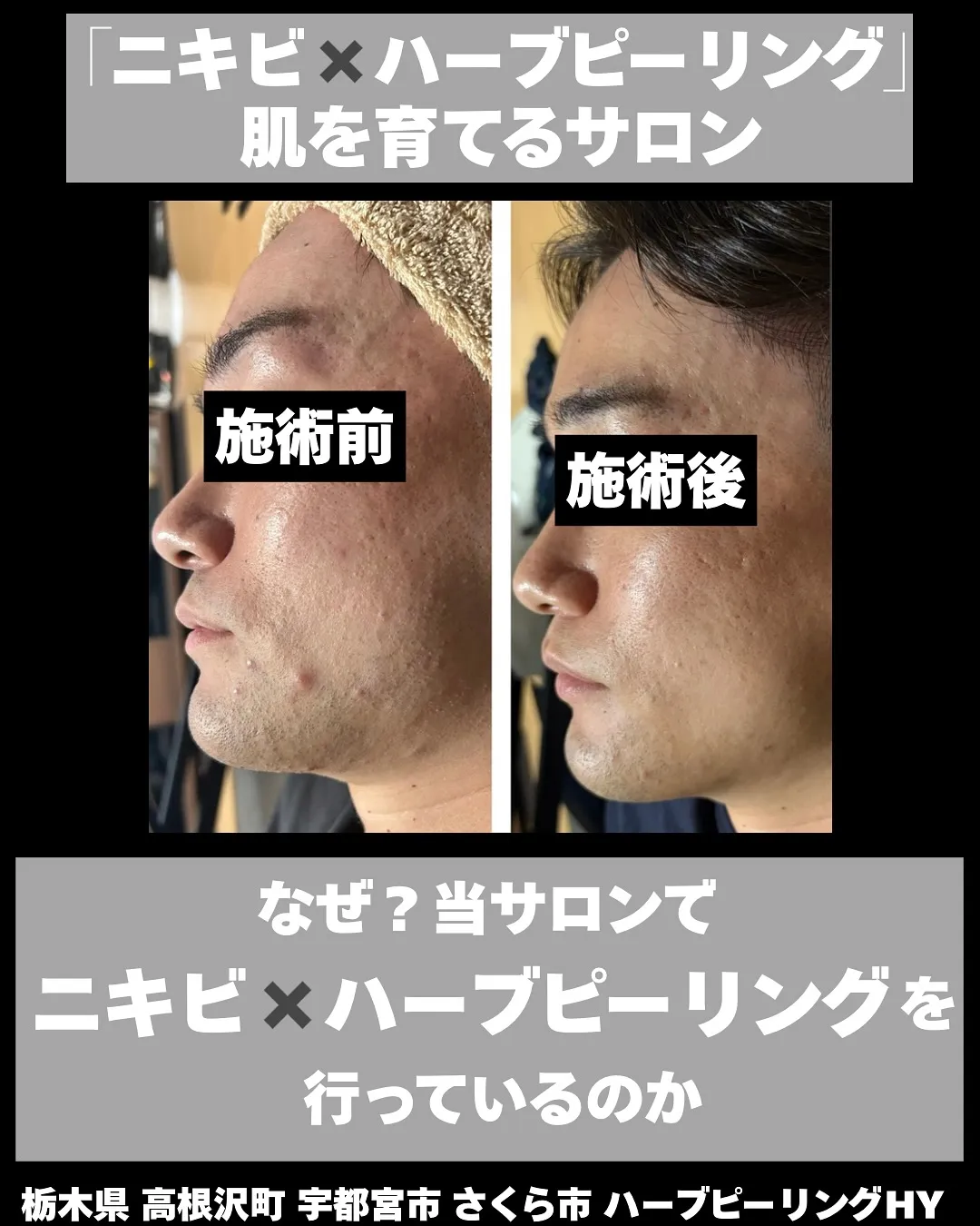 🔁【なぜニキビは何度も繰り返すの？】