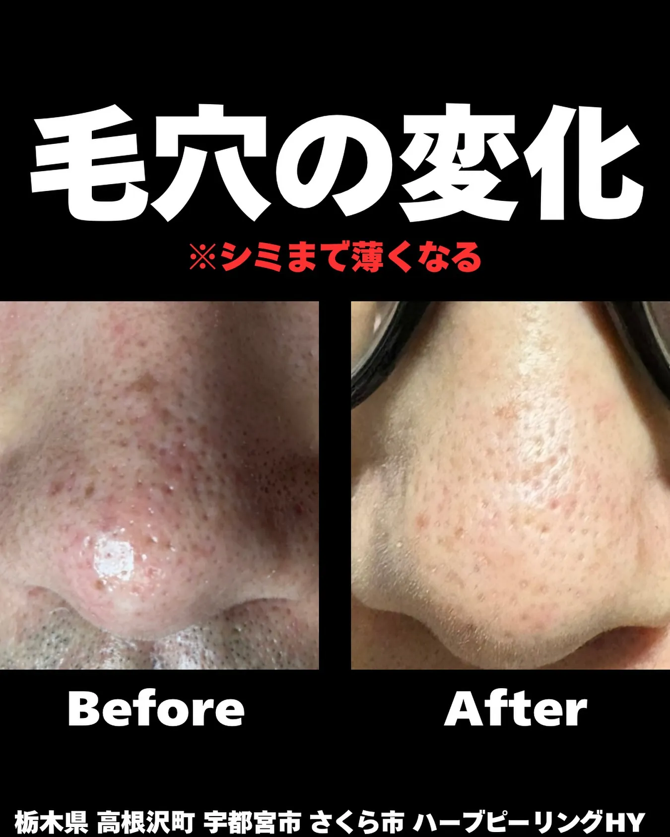 【毛穴の黒ずみ・開き、もうどうにもならないとお思いですか？🙅...
