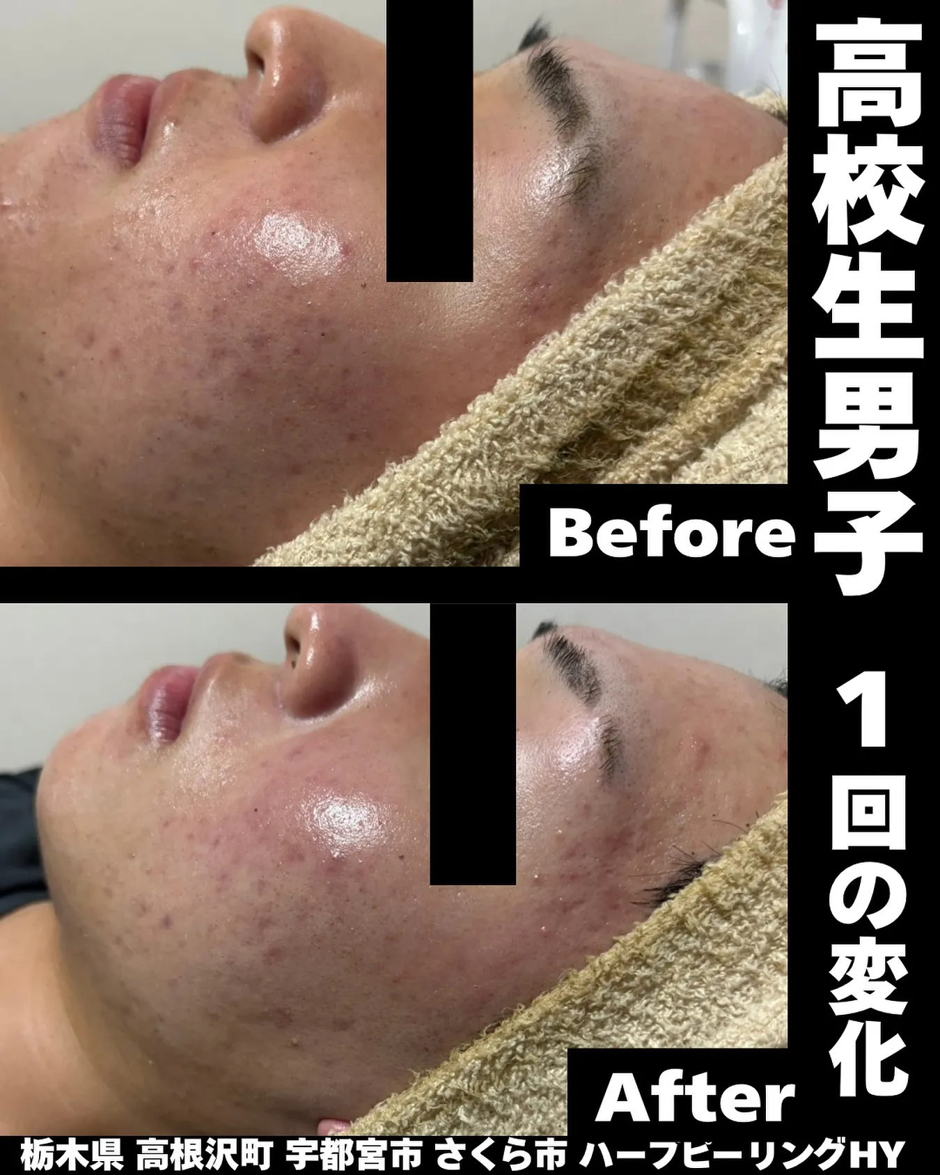 【高校生男子、たった1回のハーブピーリングでこの変化🔥】