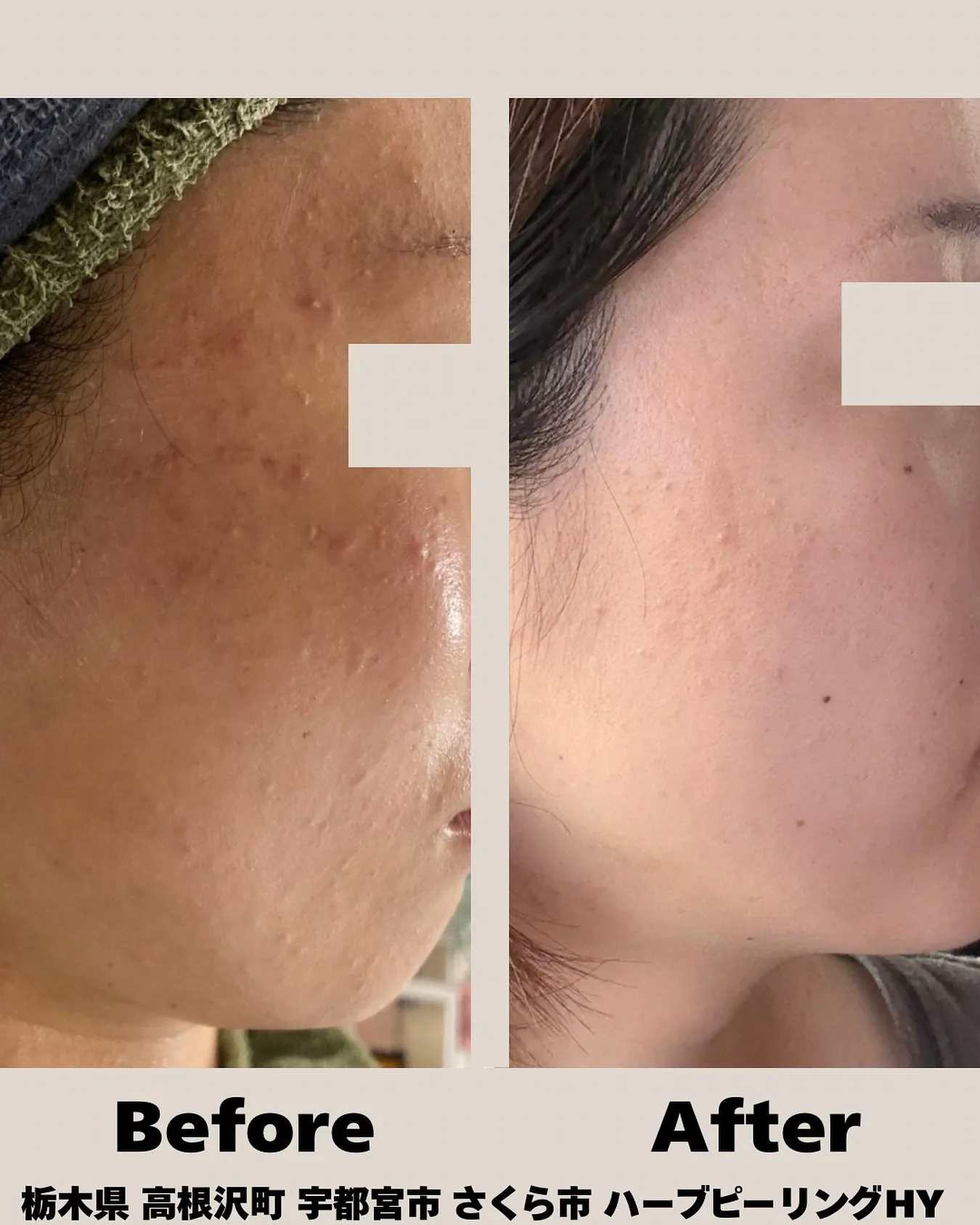 ✨Before ➡ After✨