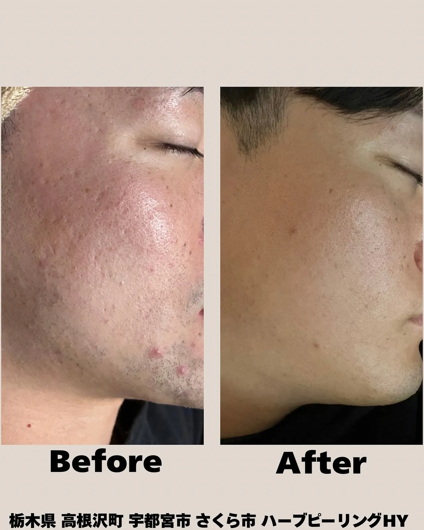 📸旦那さんの肌がここまで変わりました✨