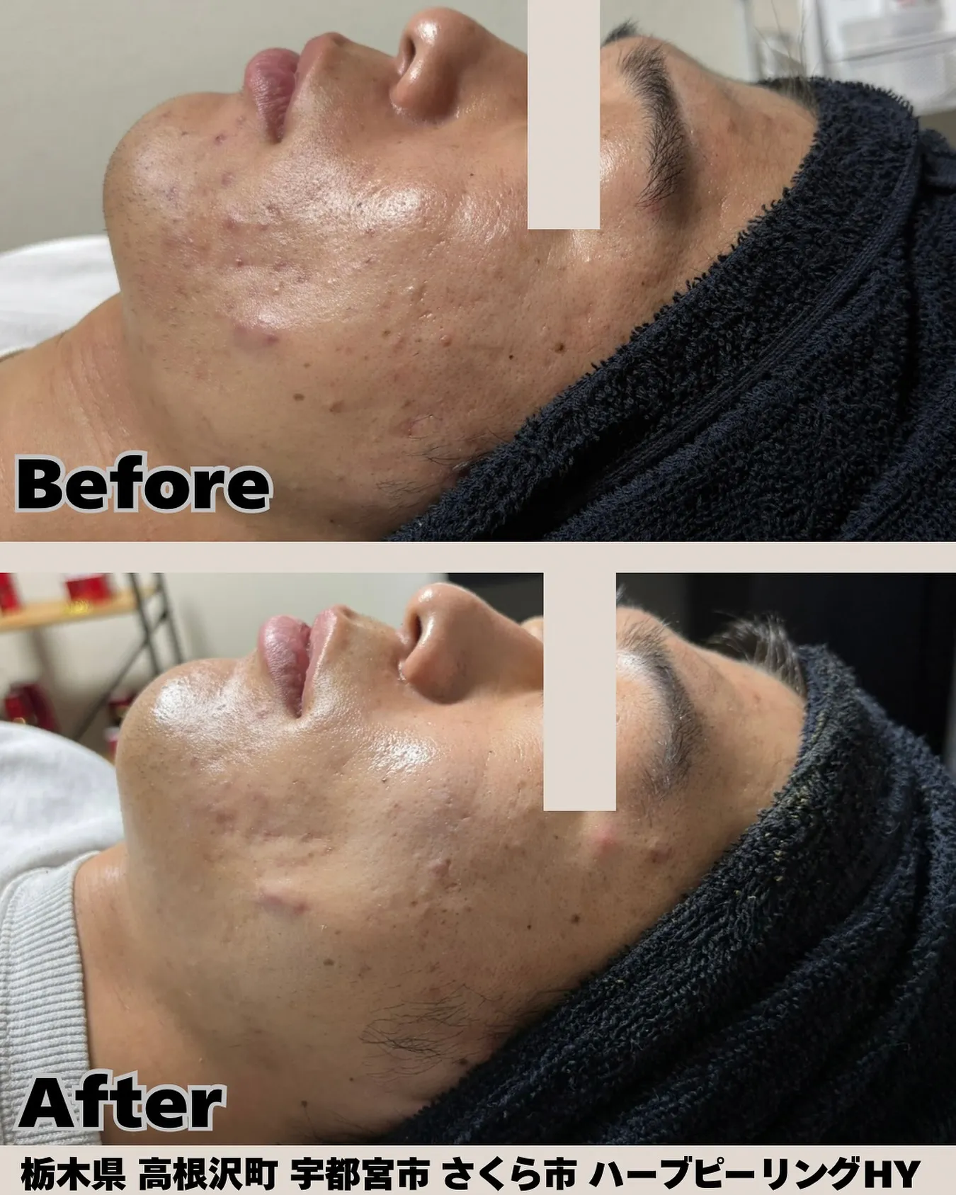 ✨施術3回でこの変化✨