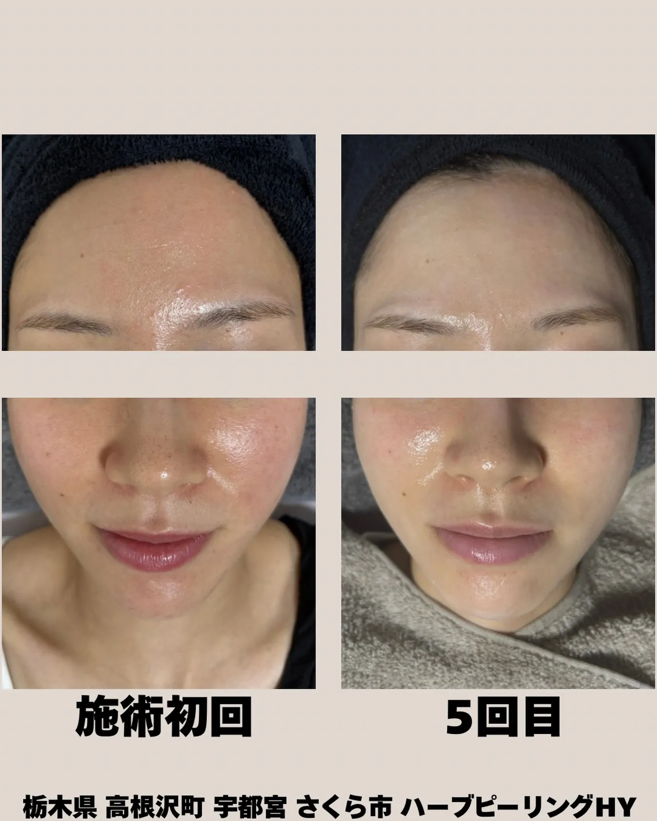 ✨【たった3ヶ月でここまで変わる✨】