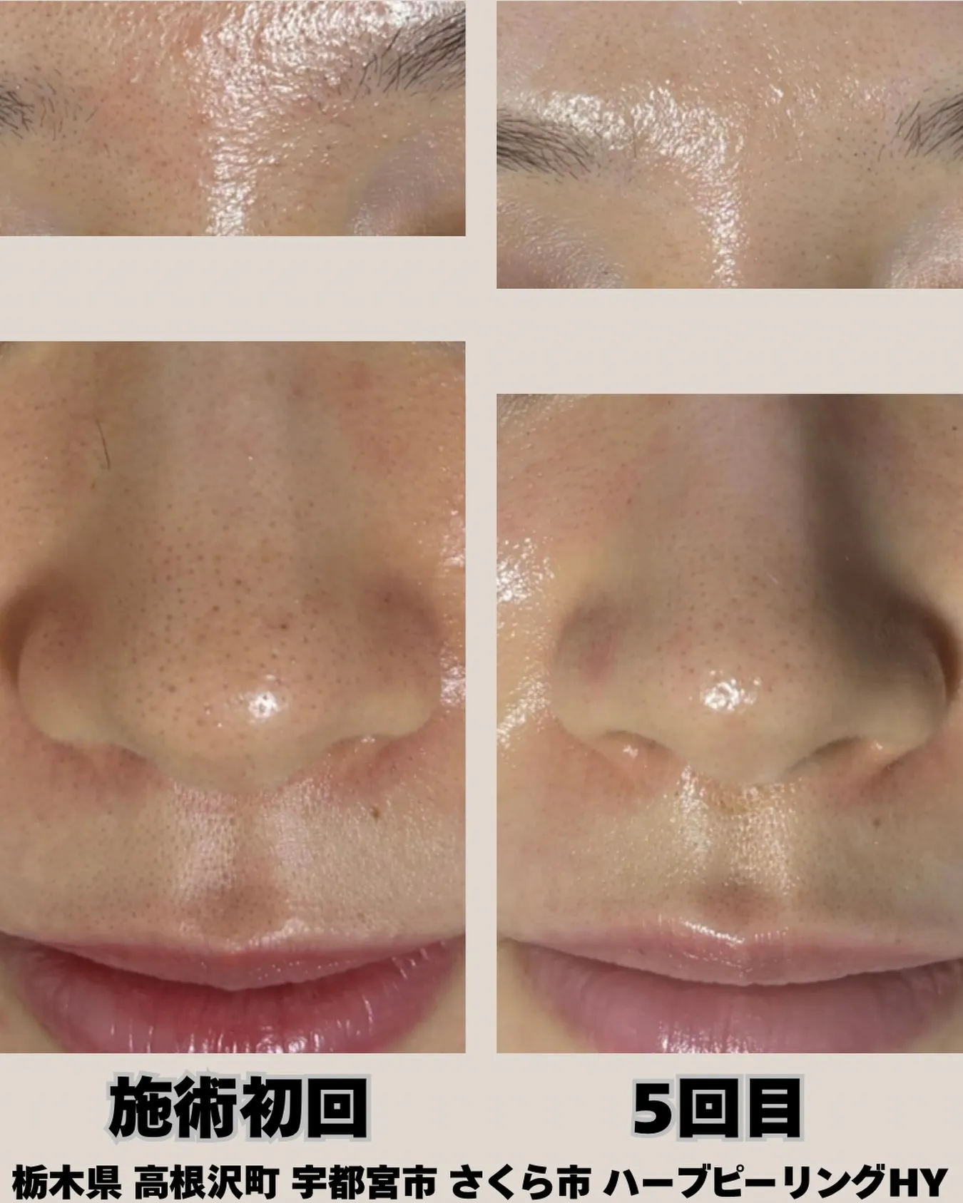 【毛穴・赤み・ザラつきがここまで変わる✨】