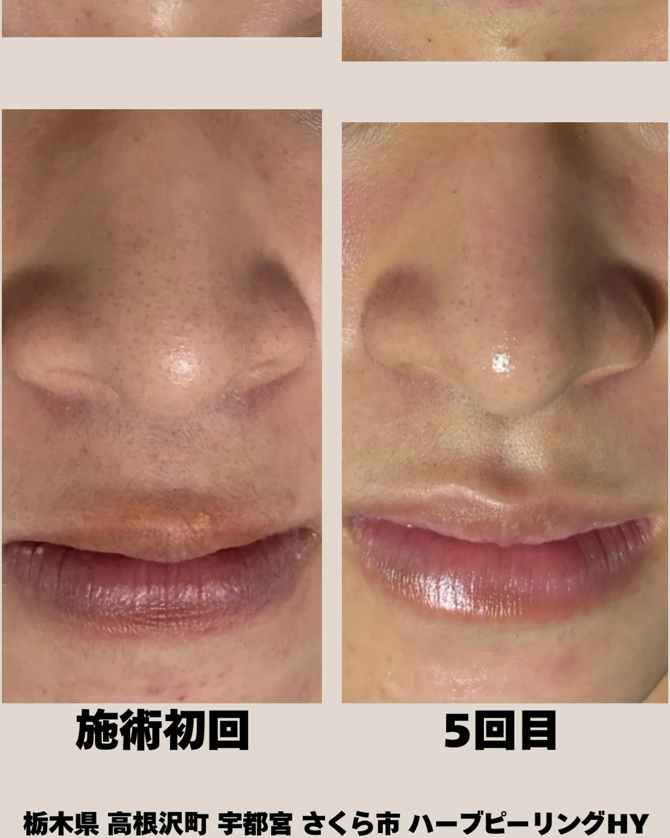 【高校生の“本気のニキビ改善”✨】