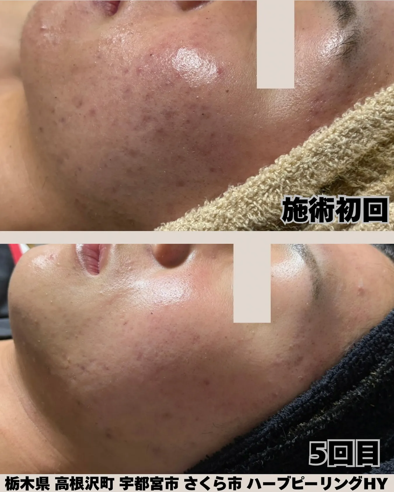 【高校生の肌、5回でここまで変わる✨】