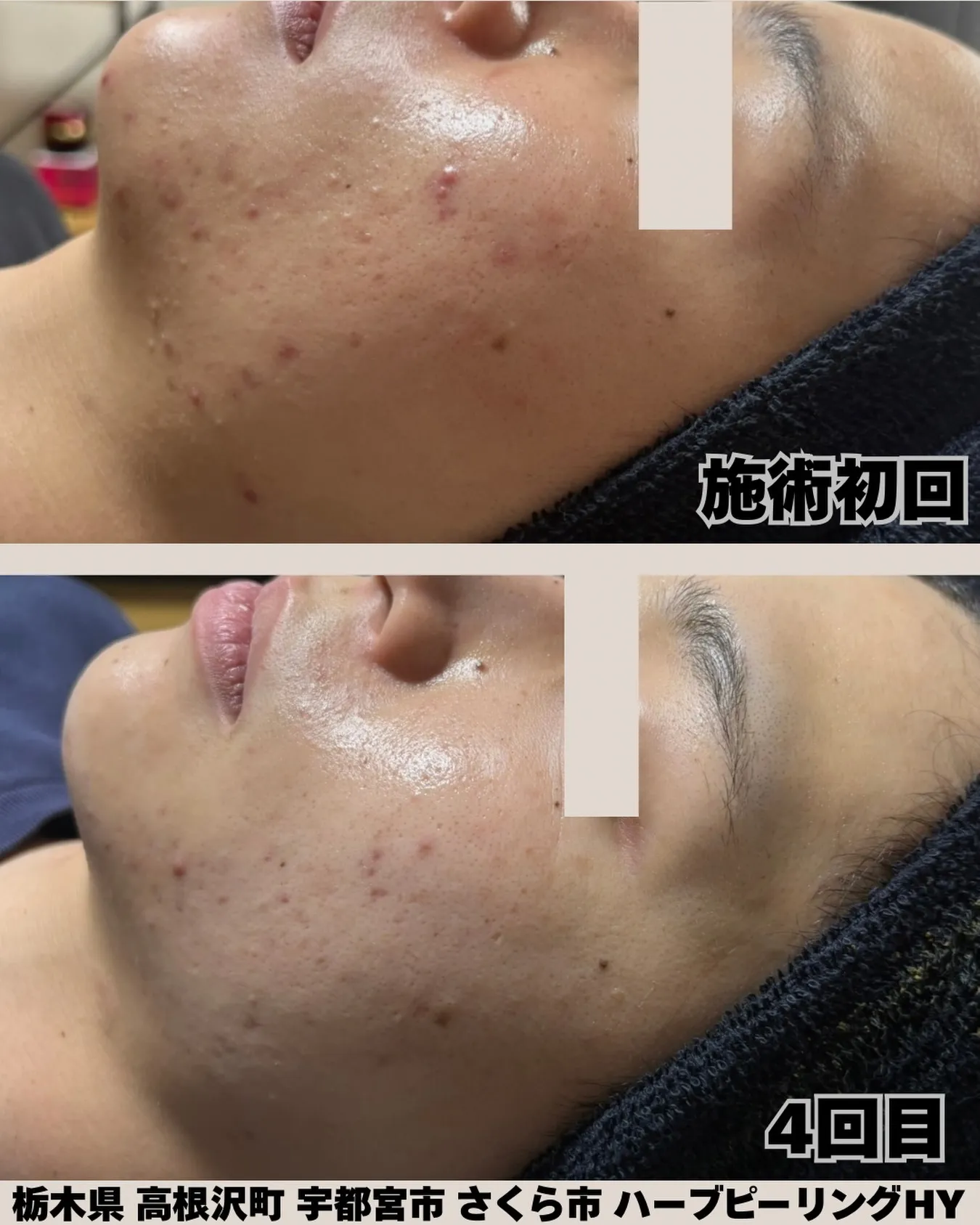 【気づいたら、ニキビが減ってた🫧】