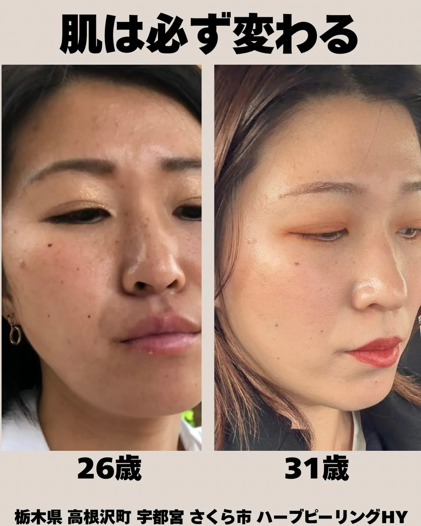 「26歳の肌」と「31歳の肌」