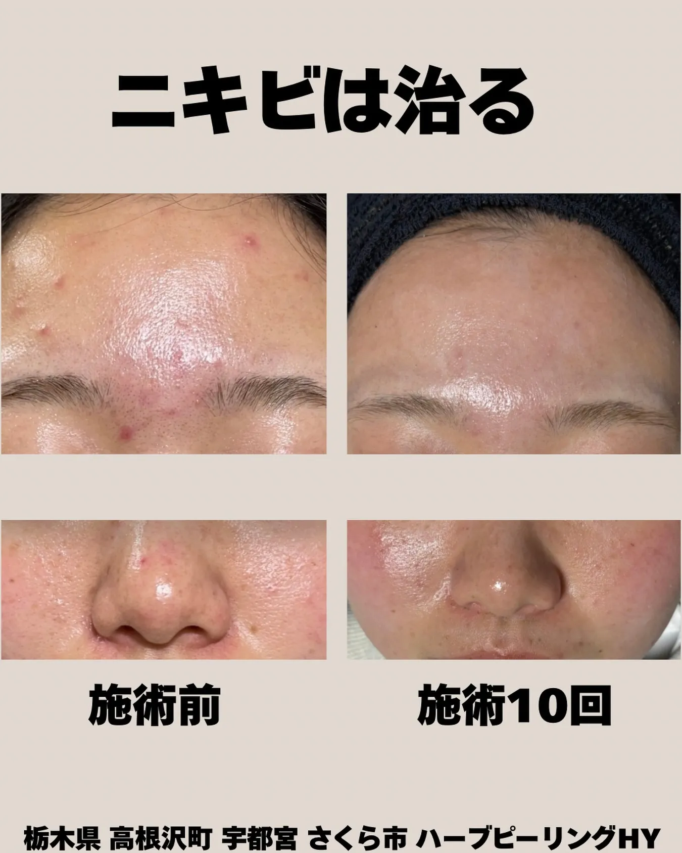 「ニキビは治る。