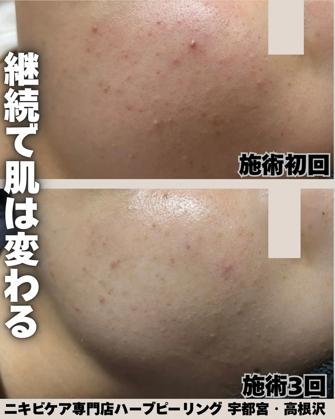 「継続で、肌は変わる🌿」