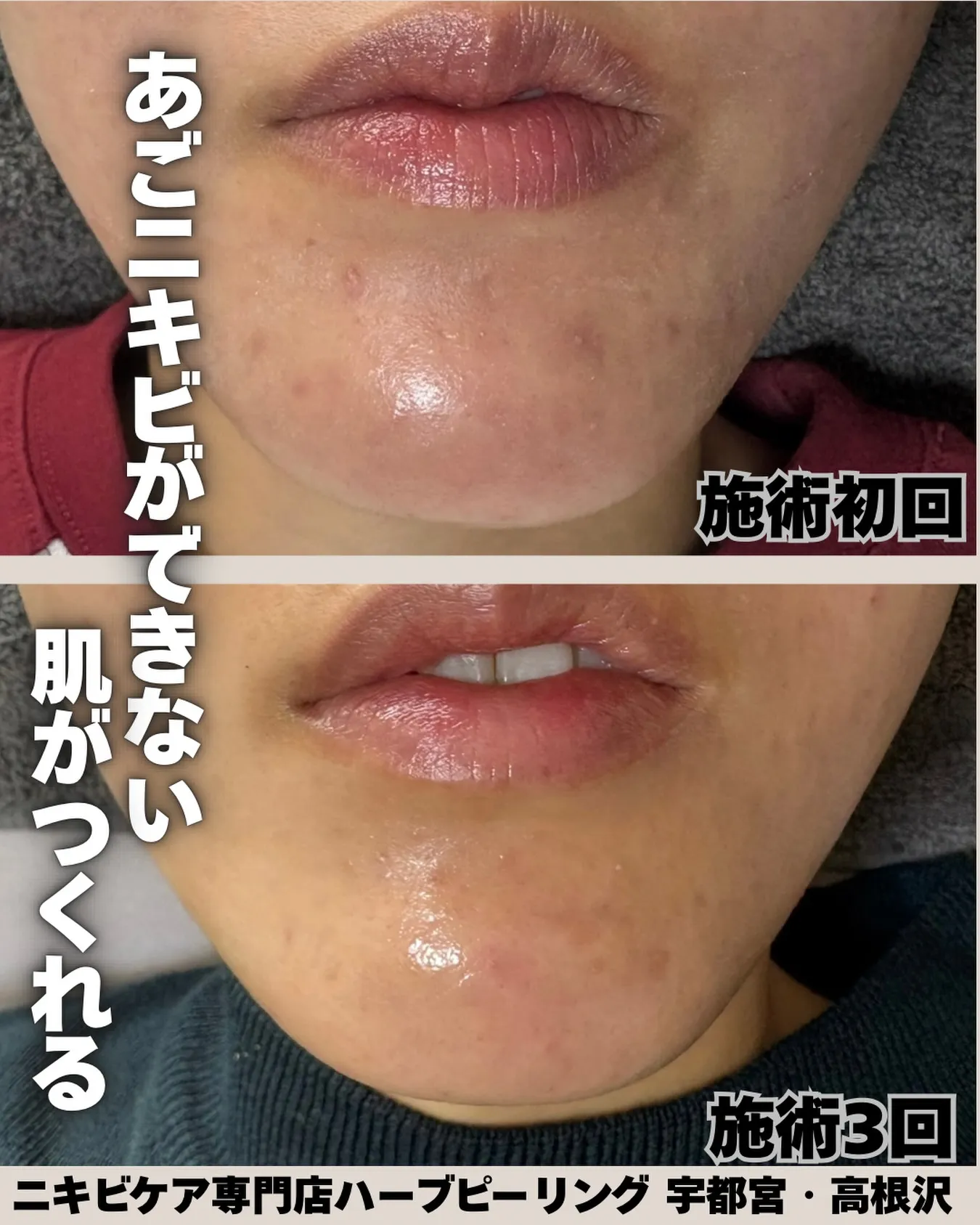 「あごだけ、ずっとニキビできる人」