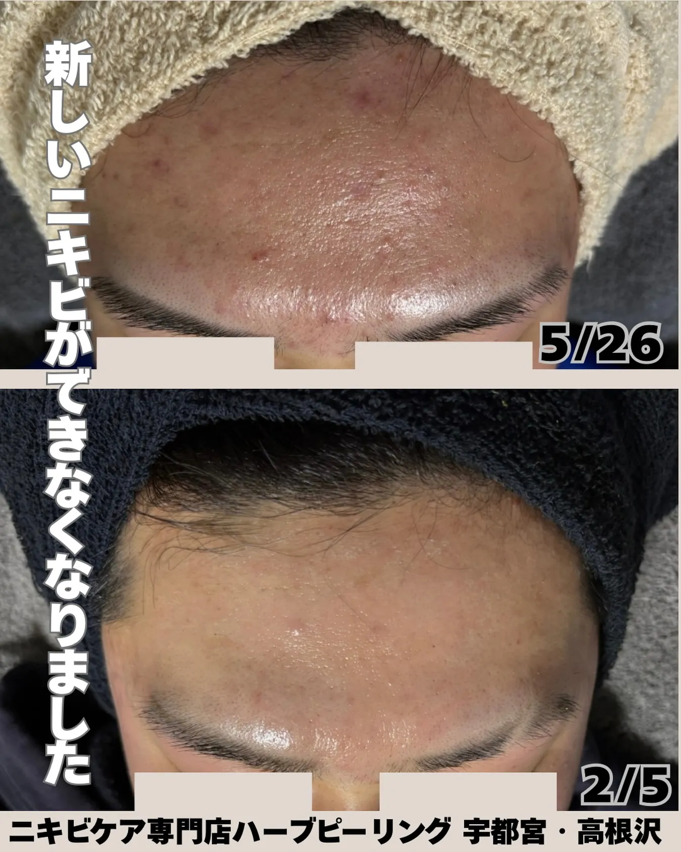 「最近、新しいニキビできなくなりました😌」