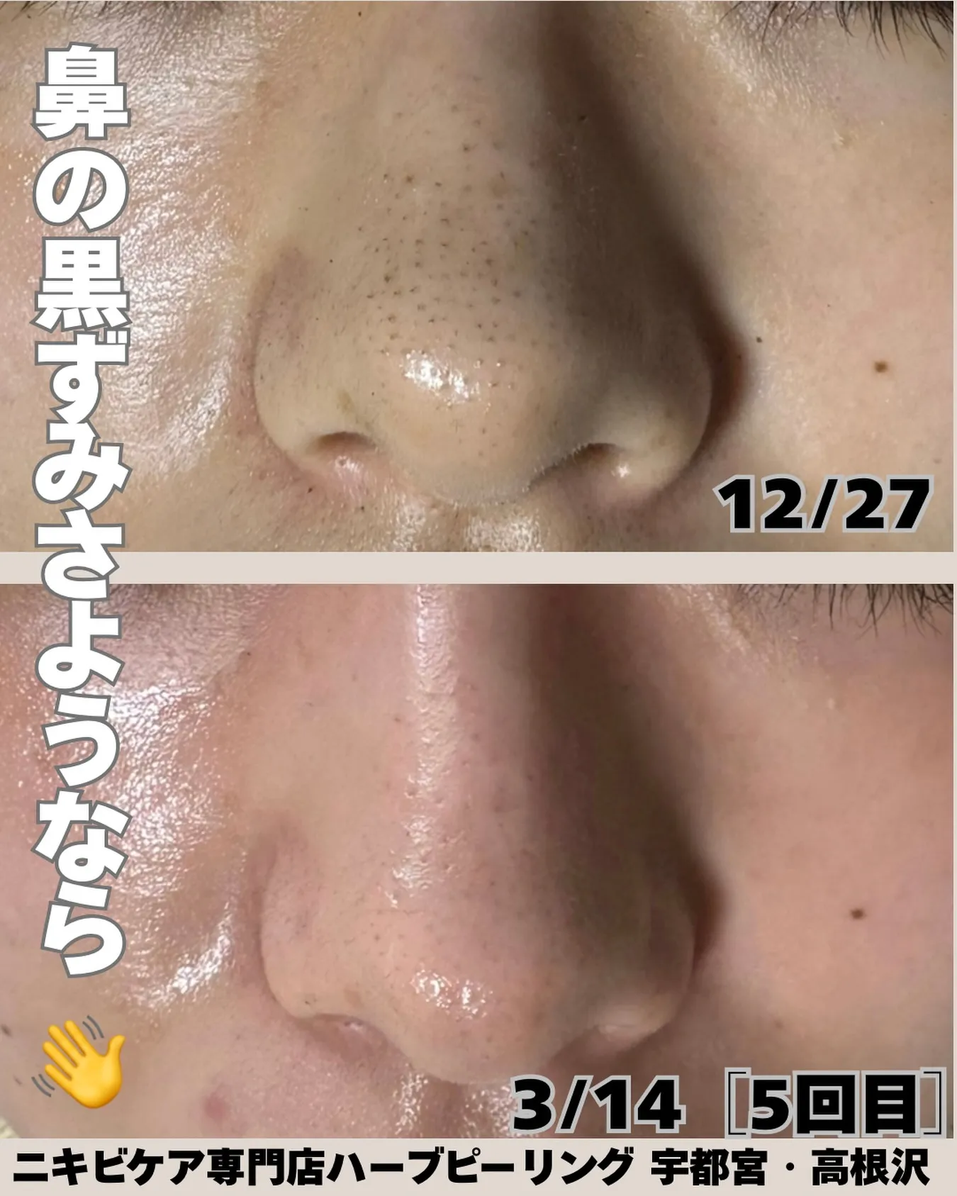 「鼻の黒ずみ、ちゃんと変わります✨」