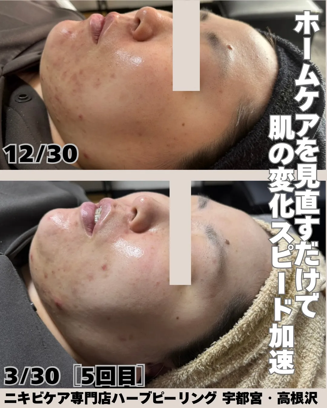 「ホームケアでここまで変わる✨」