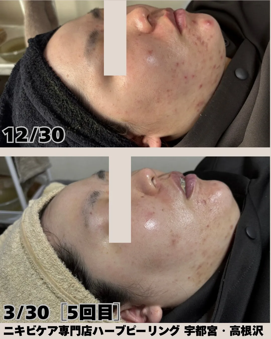 「ホームケアでここまで変わる✨」