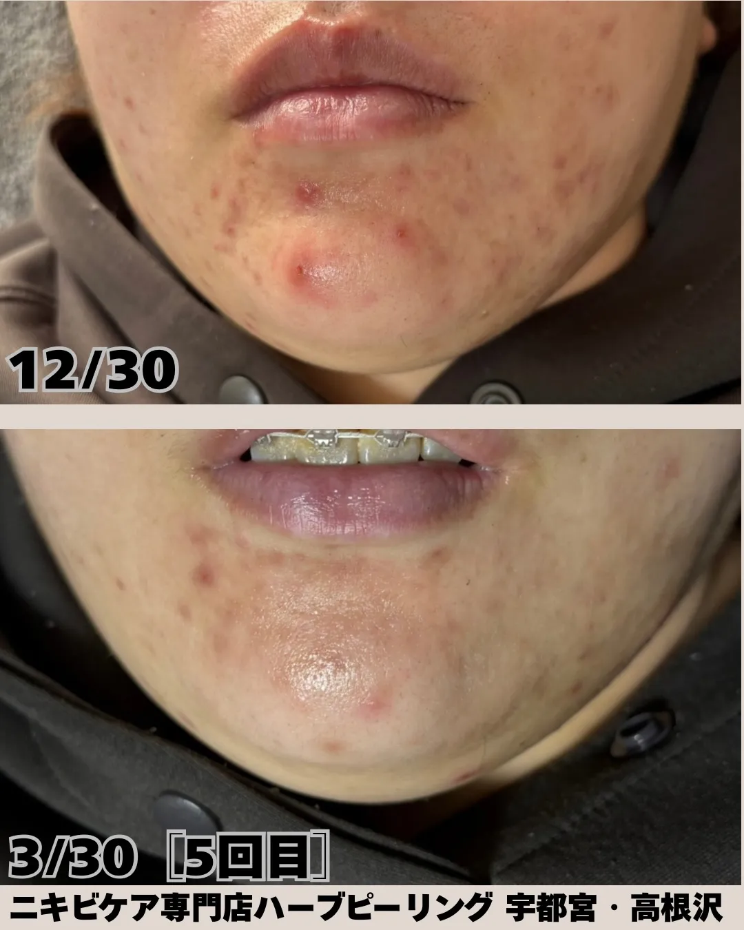 「ホームケアでここまで変わる✨」