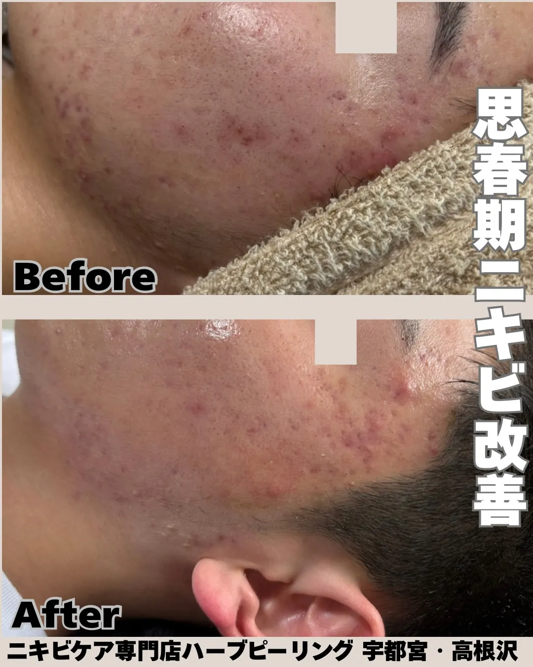 「しっかり洗ってるのにニキビができる…😢」