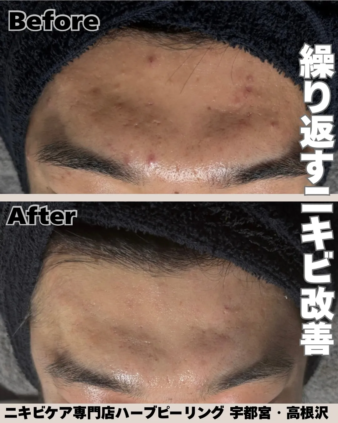 繰り返すニキビで悩んでいたお客様😢