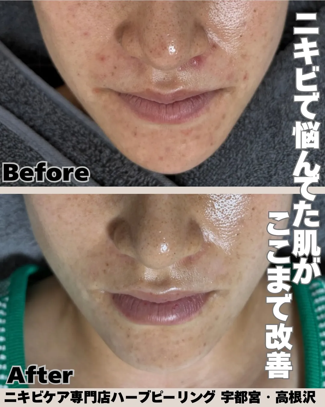 ニキビがあるだけで