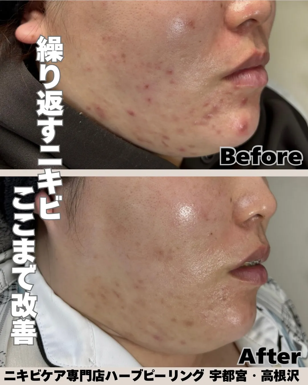 何をしてもニキビが治らない…😢