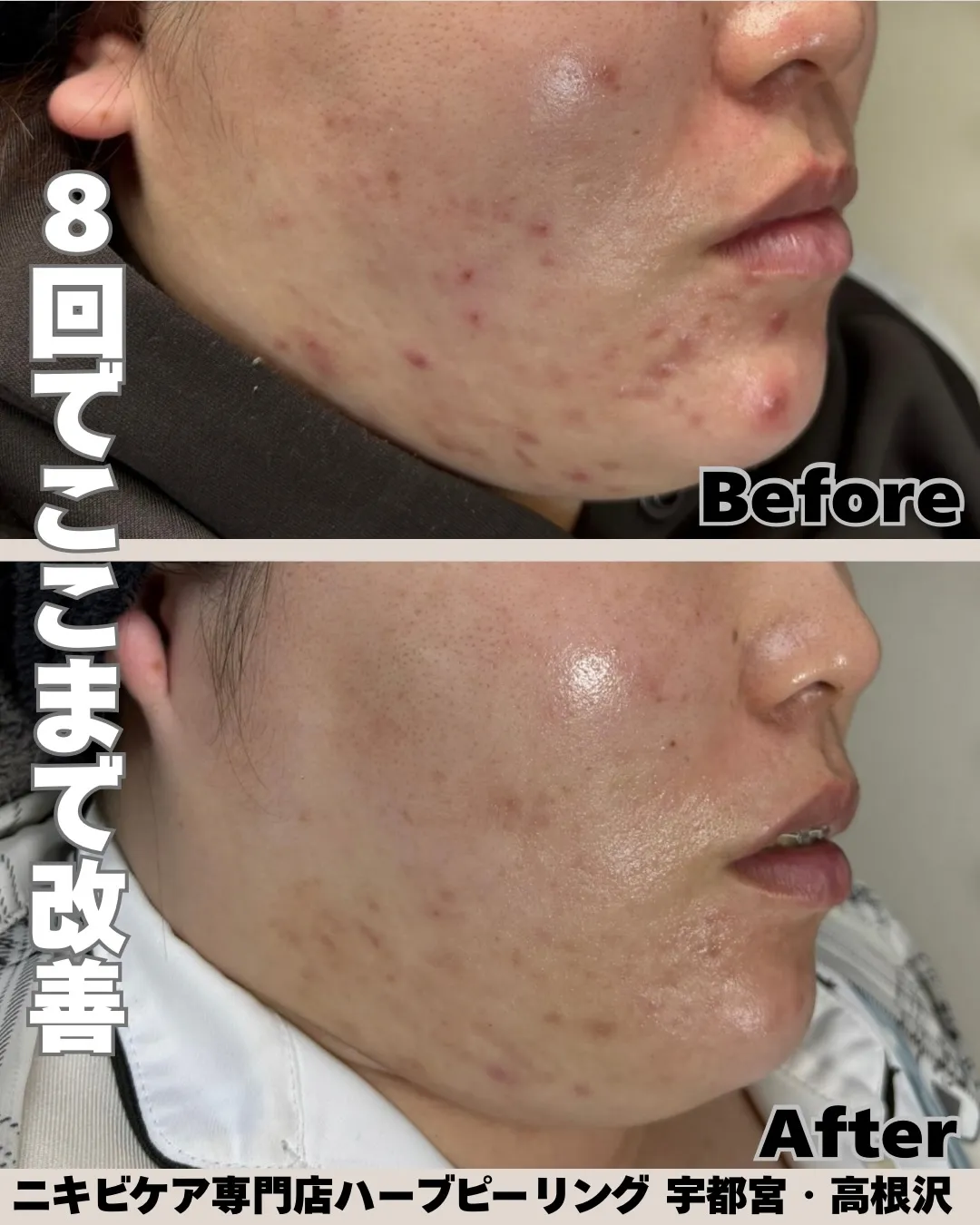 繰り返す炎症ニキビで悩んでいたお客様😢