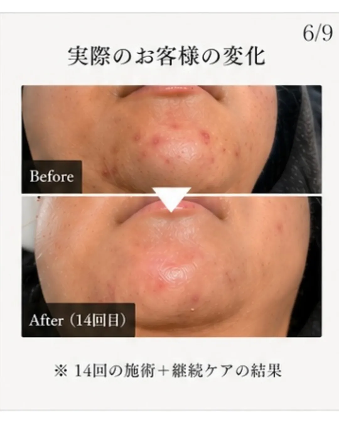 「そのニキビ、ずっと悩んでいませんか？」