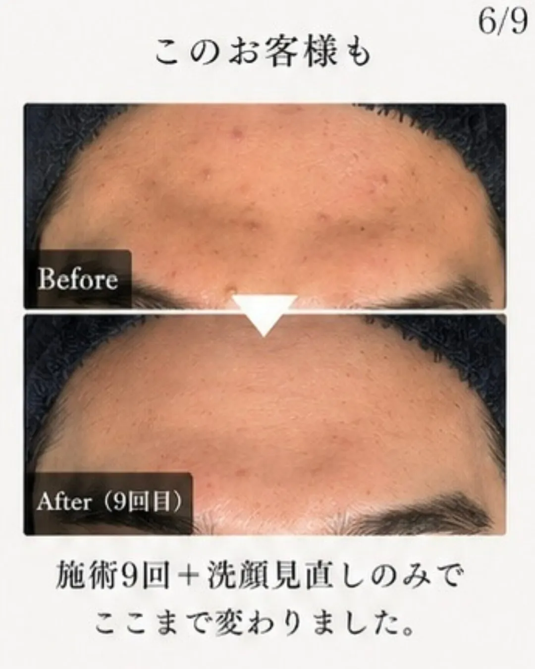 そのニキビ、「もう体質だから仕方ない」って思ってませんか？😔