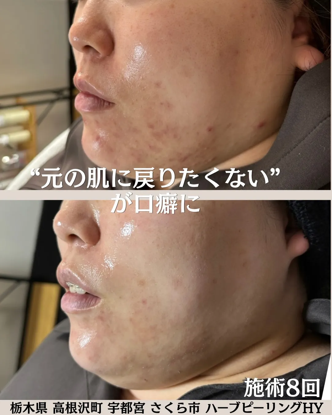 8回のハーブピーリング施術で、ここまで変わりました！