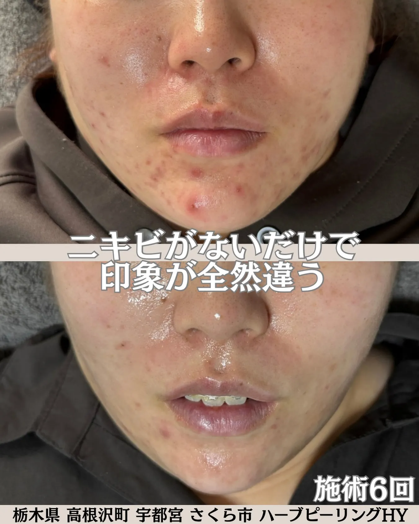 ハーブピーリング6回での素晴らしい変化です！