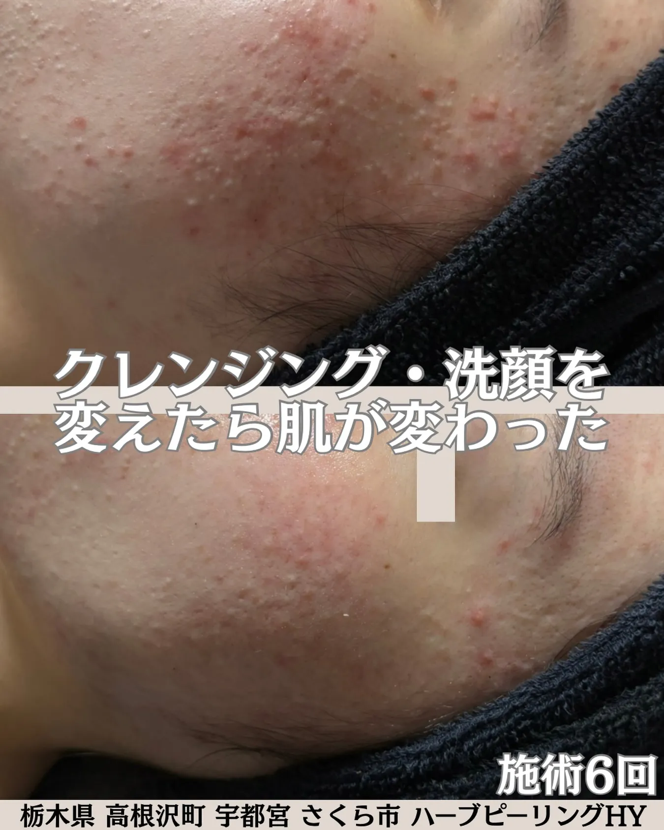 ハーブピーリング6回に通われている大学生のお客様の素晴らしい...