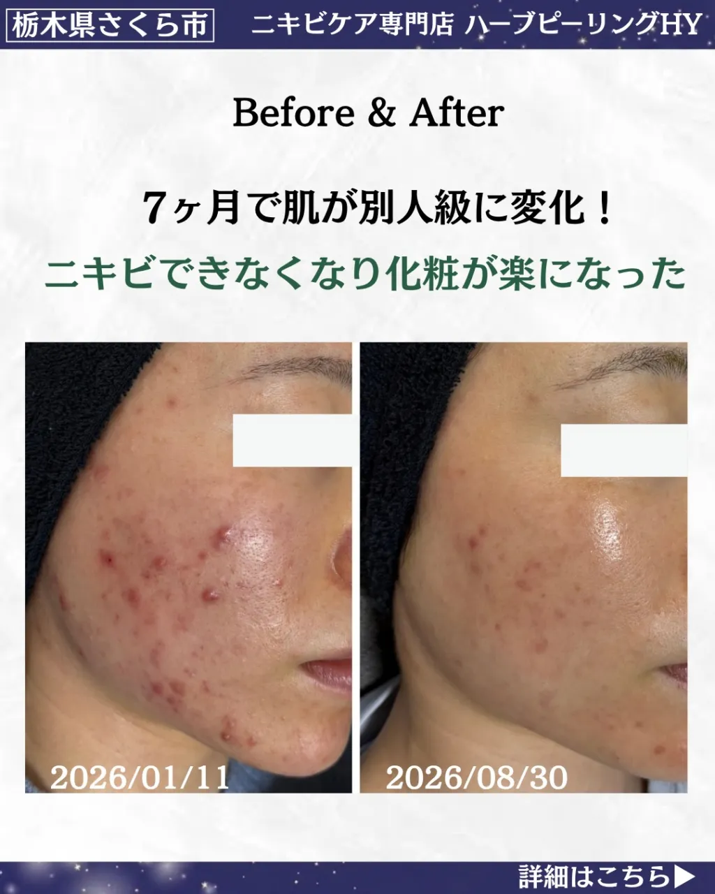 ニキビができなくなり、毎日の化粧が本当に楽になった!✨