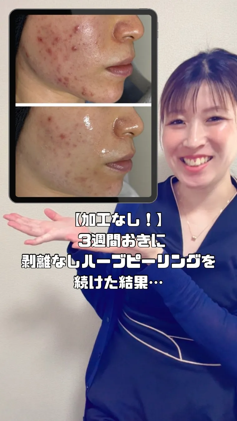 3週間おきに剥離なしハーブピーリングを続けた結果…😳！