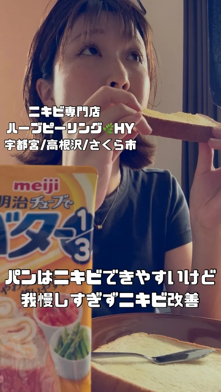 パンはニキビできやすいけど我慢しすぎないで🥐